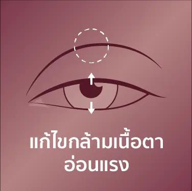 แก้ไขกล้ามเนื้อตา